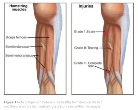 leg muscle strain